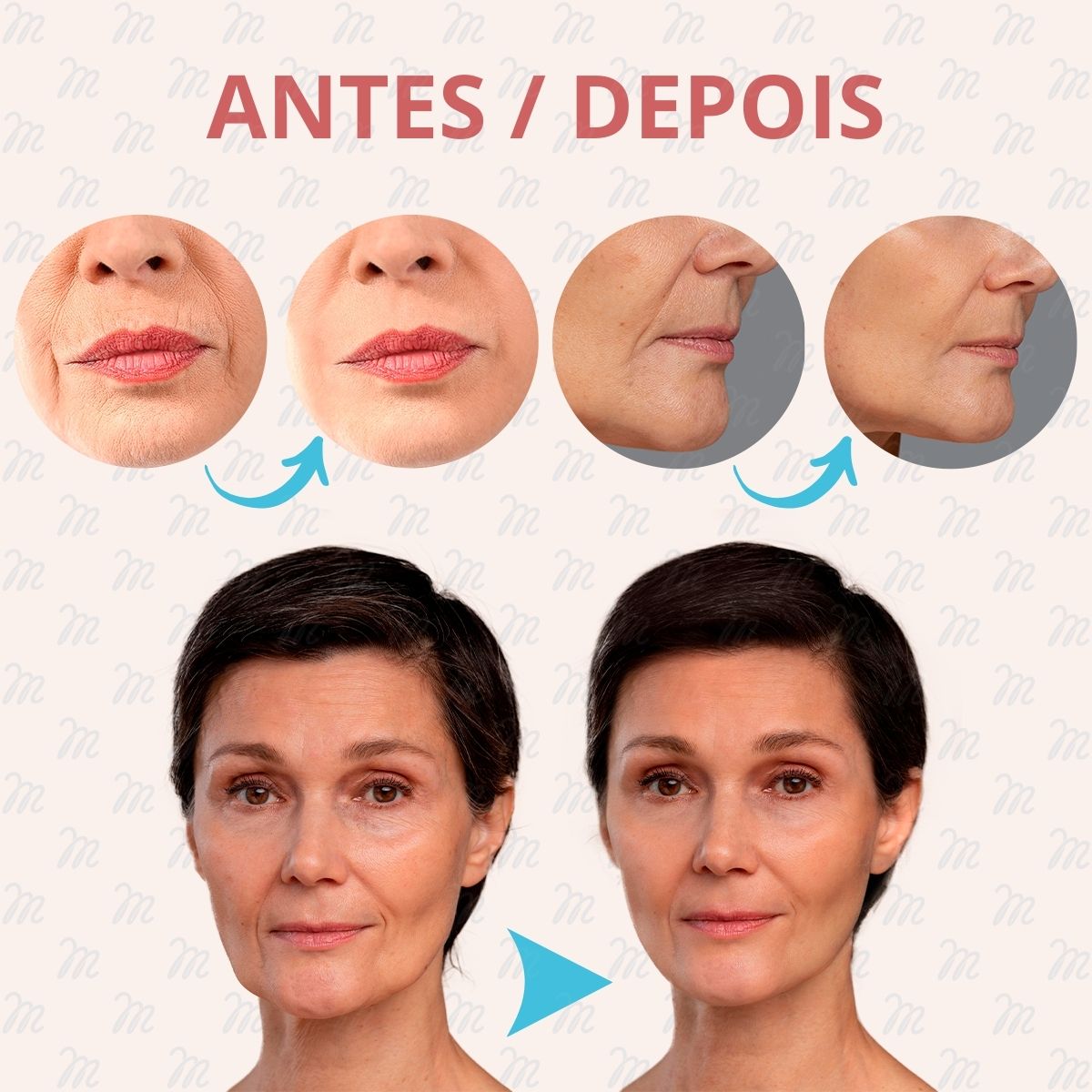 Adesivos Anti Rugas para Rosto Modelo:9 Peças